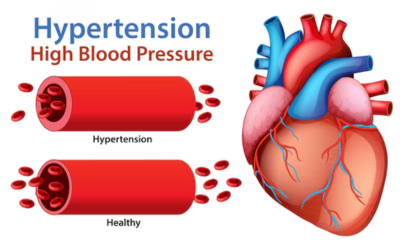 Hypertension
